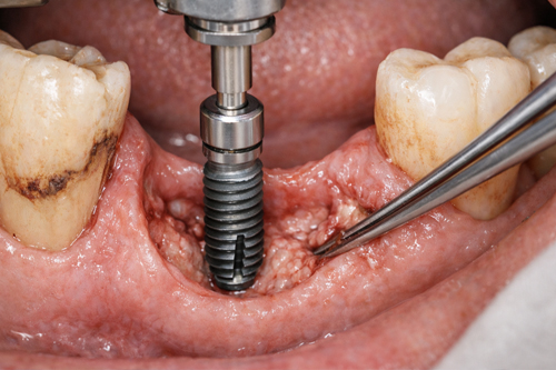 Имплантация при пародонтозе и пародонтите
