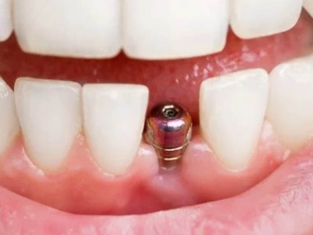 Проблемы имплантации