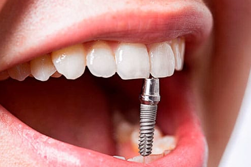 О имплантации