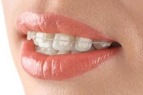 Виды брекетов