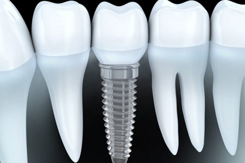 Одномоментная имплантация
