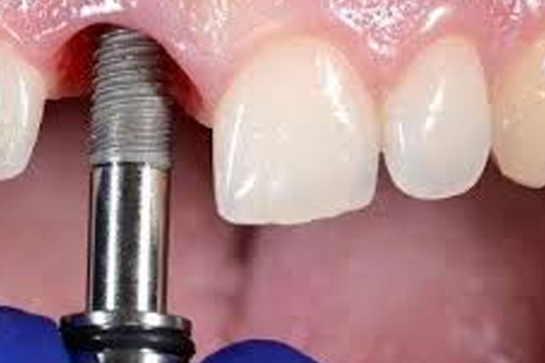 После имплантации