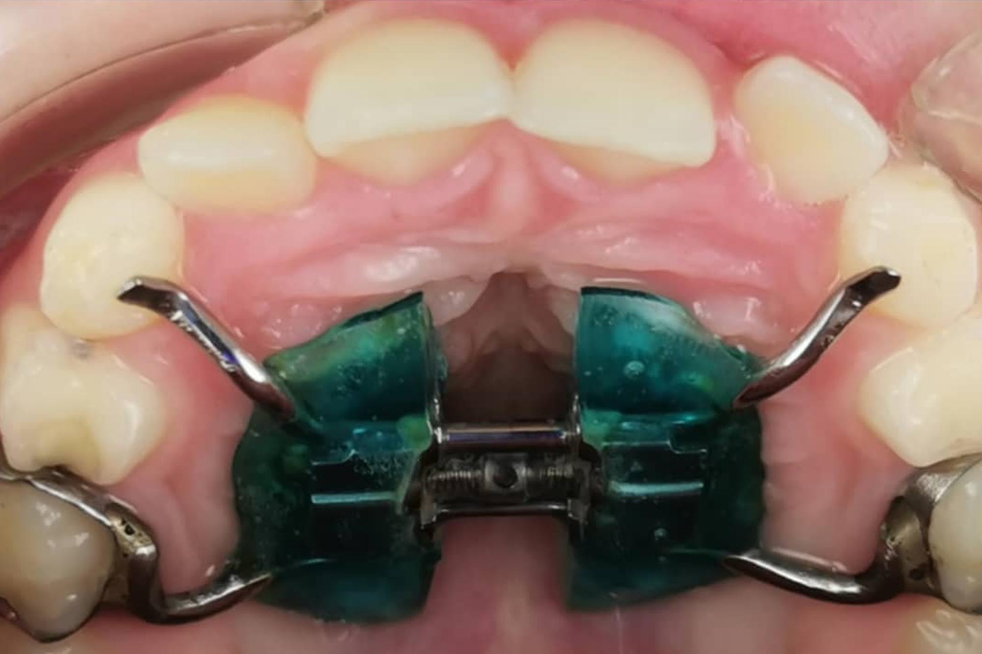 Аппарат Марко Роса