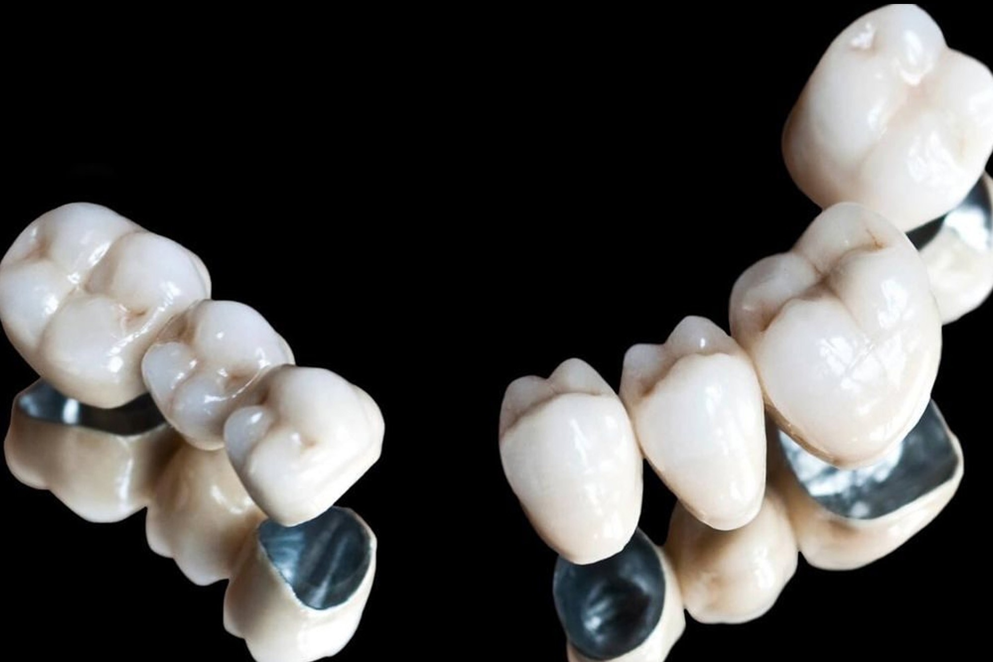 Металлокерамические коронки