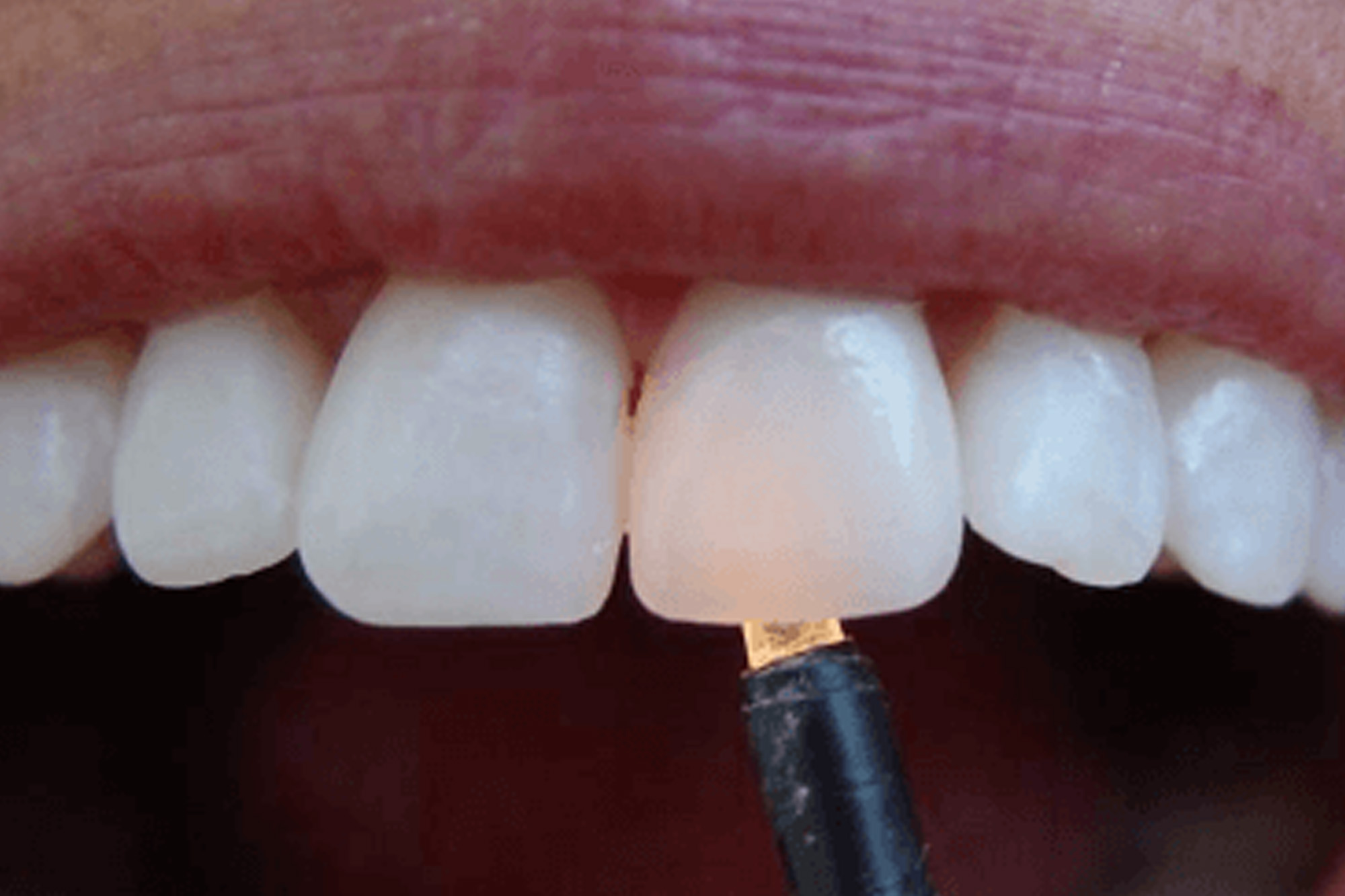 Коронки показания