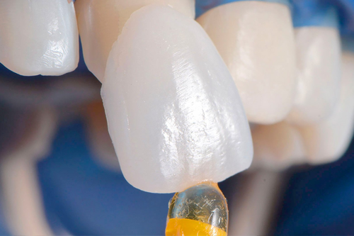 Несъемные протезы