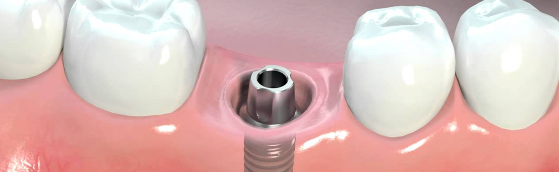 Зубные импланты