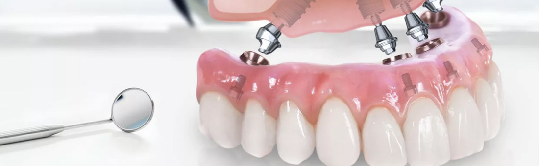 Протезирование