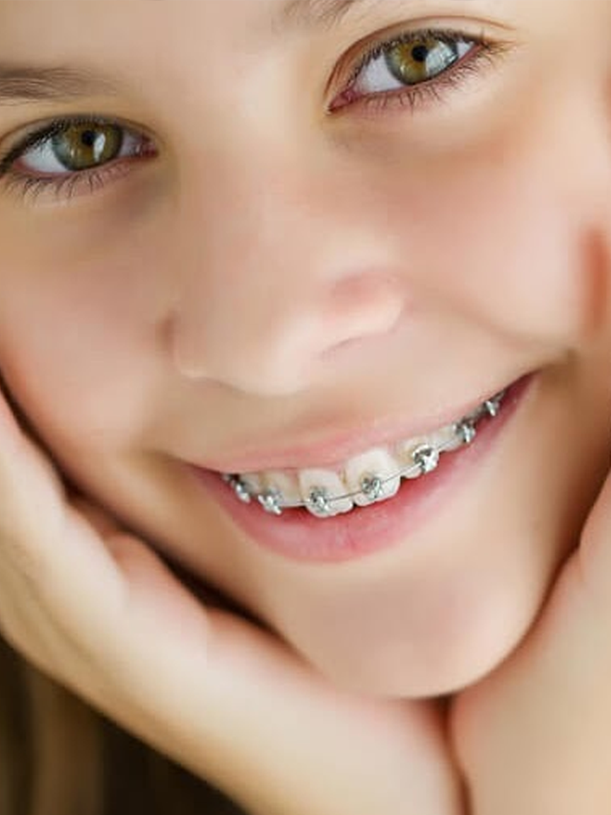 Исправление прикуса