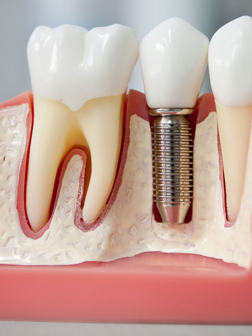 Имплантология