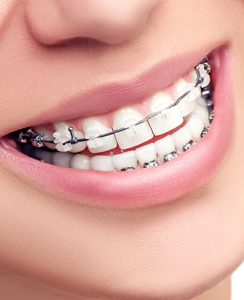 Лигатурные брекеты